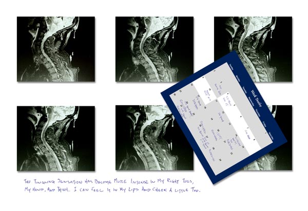 Week twelve after a TBI