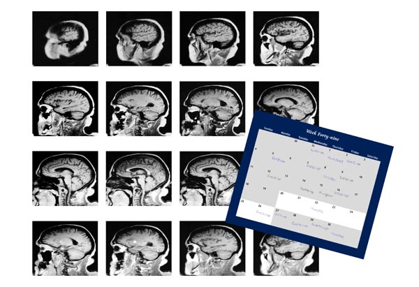 Week forty-nine after a TBI